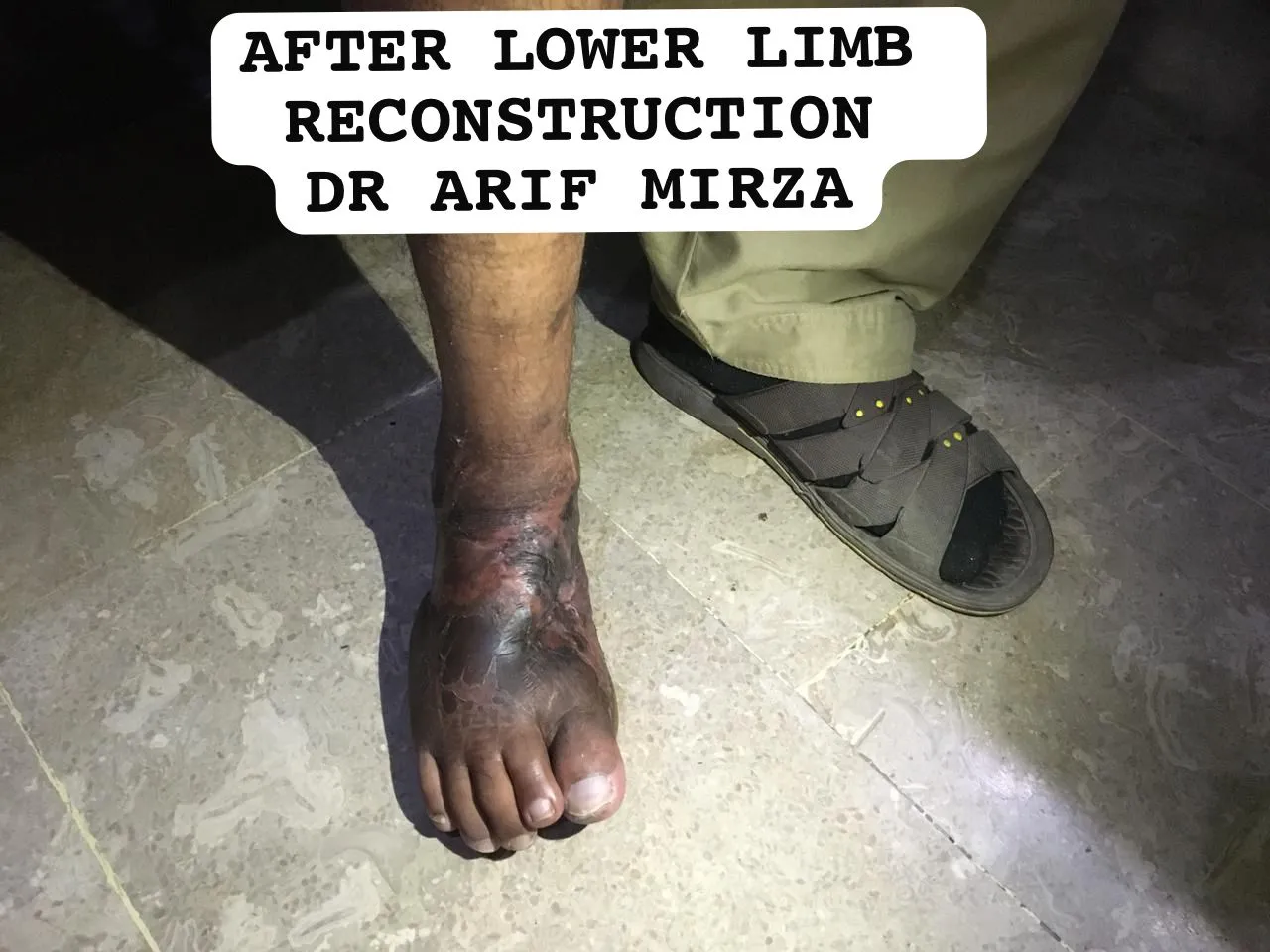 The patient's foot after lower limb reconstruction, standing on the floor with toes intact